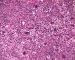 <b>Langerhans cells</b> - Humpath.com