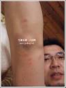 戴門的皮膚比我好被蚊子咬總是很