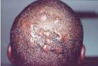 <b>Folliculitis</b> scalp