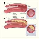 Is Unstable Angina Curable?