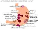 Benign Tumours and Tumour-Like Lesions of Stomach: Gastric Polyps