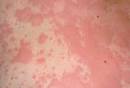 Causes of Itchy Skin Rash