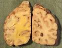 Cerebral herniations