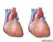 Cardiomyopathy: MedlinePlus