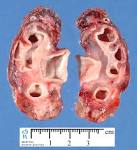 chronic interstitial <b>nephritis</b>