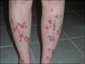 attributed to Morgellons