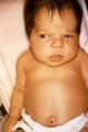 <b>Congenital hypothyroidism</b>