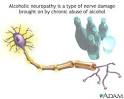 Alcoholic neuropathy: MedlinePlus Medical Encyclopedia Image
