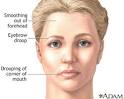 Bell's palsy