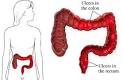 Las <b>enfermedades intestinales</b>