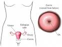 Cervical Dysplasia - Anytime Health