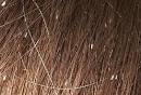 Healthy Life: Head Lice