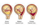 The location of your <b>placenta</b>