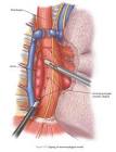 Laparoscopic Removal of Esophagus