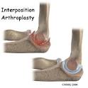 A Patient's Guide to Interposition Arthroplasty of the Elbow