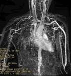 <b>Takayasu's arteritis</b>
