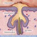  Acne Treatment   Finding a Treatment That Works Best for You