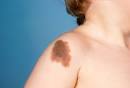 Congenital <b>Pigmented Nevus</b>