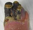 Dry <b>gangrene</b> of the 1st to 4th
