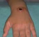 Seattle Grace Hospital: Cutaneous Anthrax