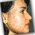 How to Remove Pimples
