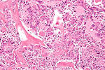 File:<b>Medullary</b> thyroid