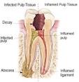 The Endodontic Group | Frisco TX | Dallas TX