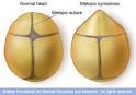 Metopic <b>synostosis</b>