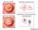Abnormal Pap smear