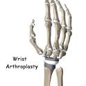 <b>Wrist</b> Conditions | Artificial <b>Joint</b> Replacement of the <b>Wrist</b>