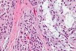 File:<b>Myoepithelioma</b> - very