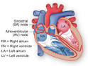 Arrhythmia - Texas Heart Institute Heart Information Center