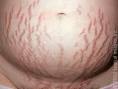 Stretchmark Pada Ibu Hamil