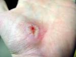 http://upload.wikimedia.org/wikipedia/commons/4/47/Hand_Abrasion_-_18_days_11_hours_43_minutes_after_injury.JPG