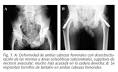 <b>de la cabeza femoral</b>