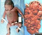 Alpha thalassemia