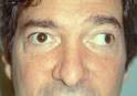 Strabismus Crossed Eyes Turned Eye Boston Plymouth Cape Cod ...