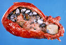 Joe Barton Publishing - <b>Gallstone</b> Removal Tips