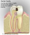 All About Cavities