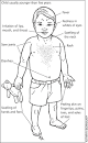 Kawasaki disease is treated