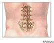 sports after a <b>back injury</b>