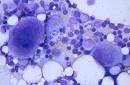 El cáncer, llamado <b>leucemia</b>
