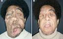 'Pascal' underwent the world's third face transplant in January 2007 to ... - face-transplant-460_794382c