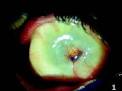Oftalmología.cu » <b>Oftalmia simpática</b>: a propósito de un caso