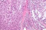 File:<b>Myoepithelioma</b> - high