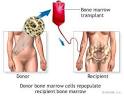 Bone Marrow Transplant | Bone Marrow