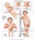 Cretinism - Netter Medical Images