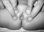 Epidermoid cyst of clitoris mimicking clitoromegaly Aggarwal SK ...
