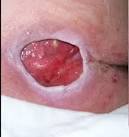 Stage IV Pressure Ulcer Taken to Surgical Closure In Only 25 Days ...
