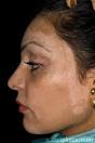 Vitiligo of the face